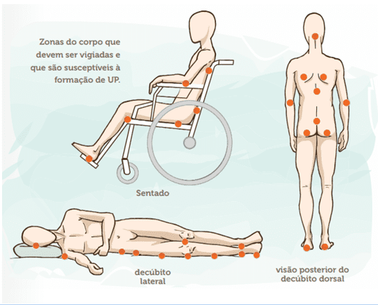 ulceras de pressao zonas de risco